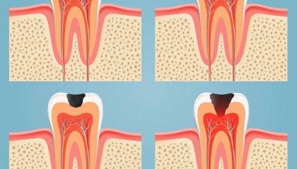 静止龋是怎么回事？