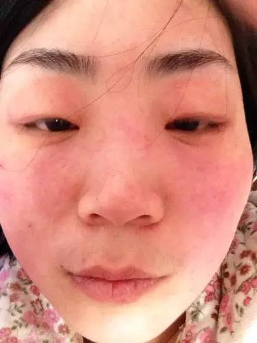 什么是干敏？什么是油敏？什么是激素敏？？